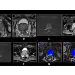 MRI's Role in Prostate Cancer Screening