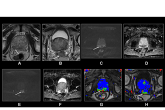 MRI's Role in Prostate Cancer Screening