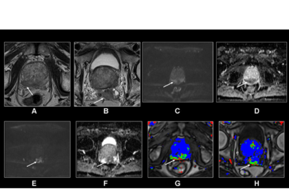 MRI's Role in Prostate Cancer Screening