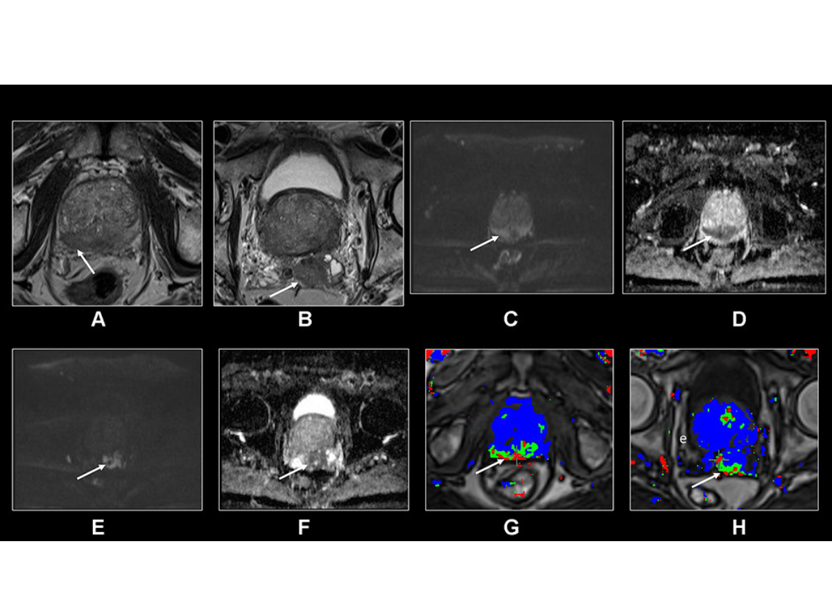 MRI's Role in Prostate Cancer Screening